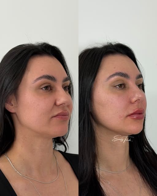 Antes e depois de contorno de mandíbula